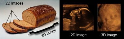 2D vs 3D Ultrasound Scan